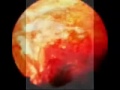 Mesothelioma Disease Mesothelioma Disease
