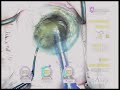 cataract surgery phaco chop by Uday Devgan MD Los Angeles cataract surgery phaco chop by Uday Devgan MD Los Angeles