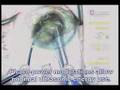 Phaco Chop Technique In Cataract Surgery Phaco Chop Technique In Cataract Surgery
