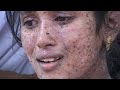 Miracles Of Jesus | Christian Supernatural Miracle Testimony Of Sindhuja - Tamil Christian Testimony