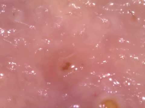 how to get rid demodex