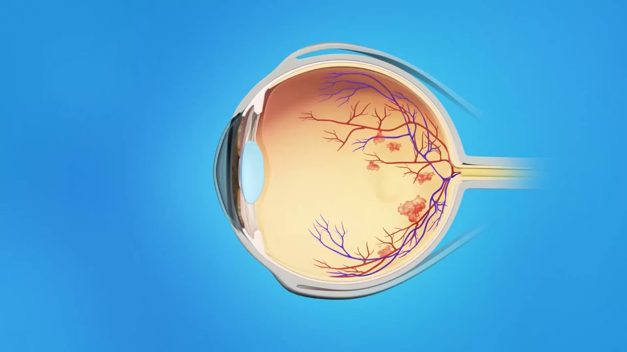 Retina Diabetic Injection Macular Edema