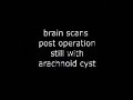 brain scans with arachnoid cyst, pre + post op