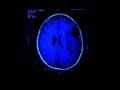 brain scans with arachnoid cyst, pre + post op