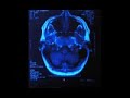 brain scans with arachnoid cyst, pre + post op