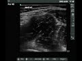 Ultrasound views of the femoral nerve