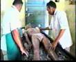 Panchakarma therapy