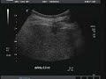 Bi�psia hep�tica guiada por Ultra-som Contrastado