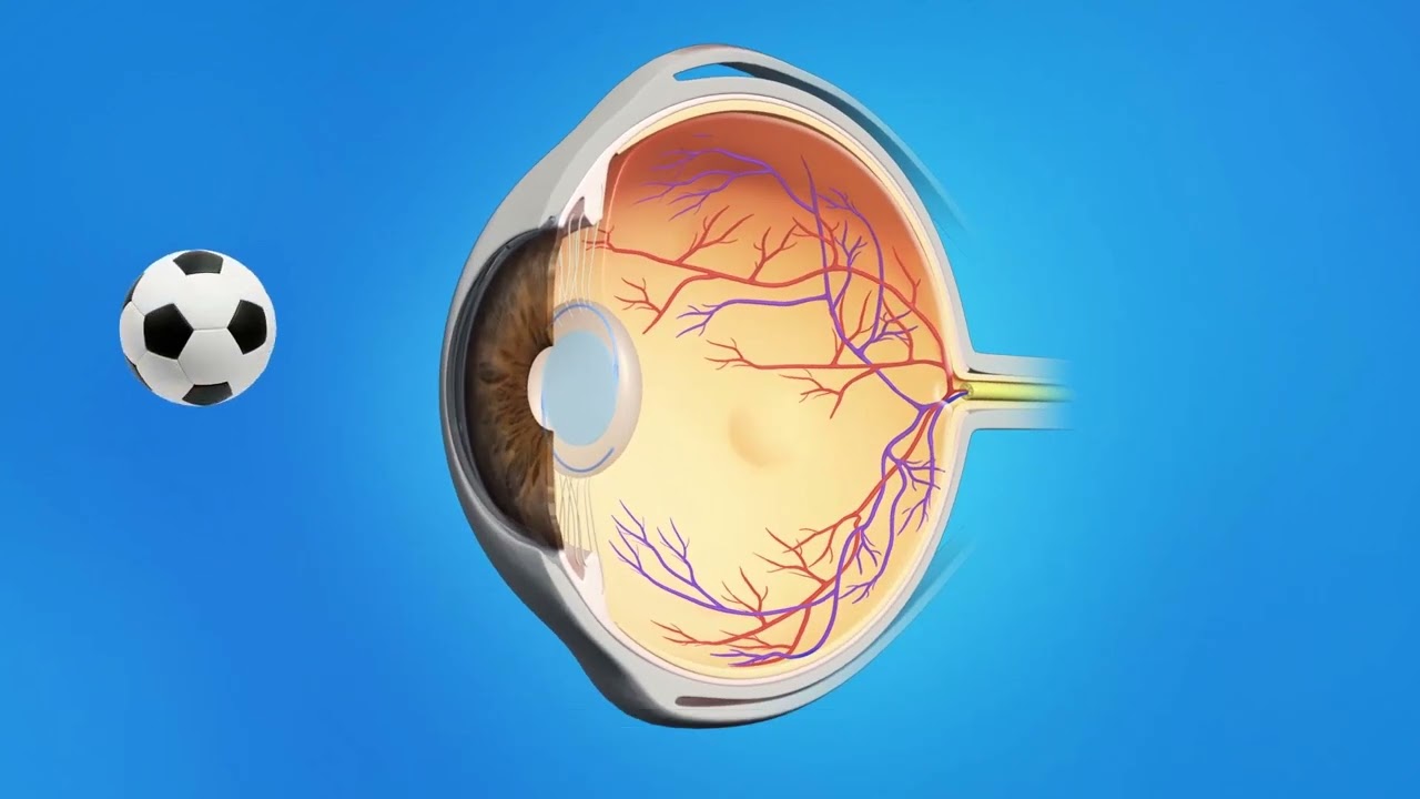 Cataract Phaco with Toric Lens