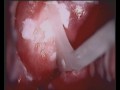 Taking a smear with the Szalay Cyto-Spatula Pap test device