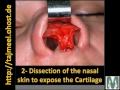 Rhinoplasty ????? ????? Dr. Mohamed El-Rouby ?. ???? ?????? Rhinoplasty ????? ????? Dr. Mohamed El-Rouby ?. ???? ??????