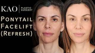 No One Knew She Had A Facelift (Until Now!) Plastic Surgery Before and After