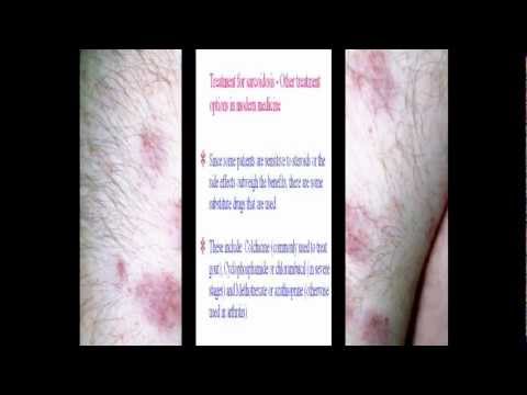 how to cure granuloma