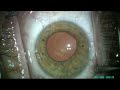 CIRUGIA DE CATARATA CON LENTE INTRAOCULAR BIFOCAL