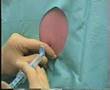 S.O. Klinik - Epidural Anestezi