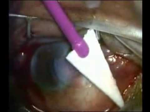 how to cure pterygium