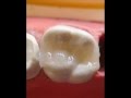 videos de RESTAURACÃO RESINA COMPOSTA.wmv