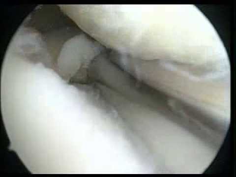 knee Arthroscopy with medial ...