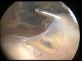 knee Arthroscopy with medial menisectomy and plica excision knee Arthroscopy with medial menisectomy and plica excision