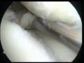 knee Arthroscopy with medial menisectomy and plica excision