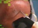Epilation laser. Peaux noires. Laser Yag