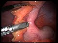 Laparoscopic appendectomy for acute appendicitis