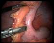 Laparoscopic appendectomy for acute appendicitis