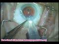 Anterior Vitrectomy & Cortex Removal During Cataract Surgery Anterior Vitrectomy & Cortex Removal During Cataract Surgery