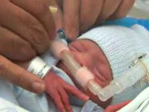 CPAP (Continuous Positive Airway ...