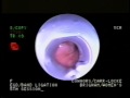 Varice oesophagienne