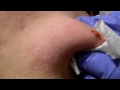Twigg Bens Big Cyst