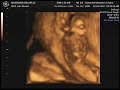 Week 12 Ultrasound with Quintuplets Week 12 Ultrasound with Quintuplets