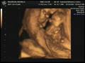 Week 12 Ultrasound with Quintuplets