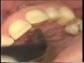 ORTHODONTIE LINGUALE
