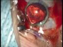 RLE and Alcon single piece IOL implantation - full nonedited video