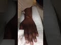 Ganglion Cyst Drain....