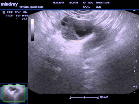 Видео: Что такое фолликулометрия и когда ее делают