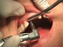 fast extractions fast extractions
