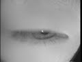 positional nystagmus 1 positional nystagmus 1