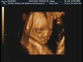 Ecografia 3D Stefanny Pe�a Cubillos