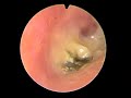 FUNGAL OTITIS EXTERNA