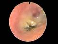 FUNGAL OTITIS EXTERNA