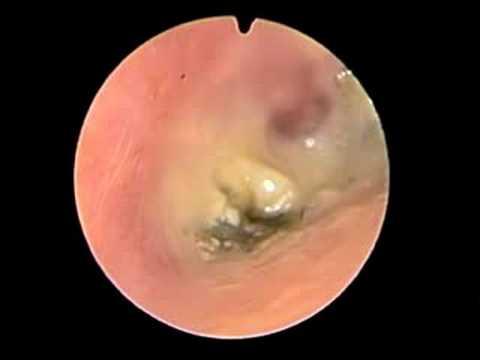 how to drain otitis externa