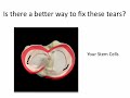 What is a knee meniscus tear?
