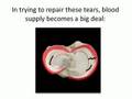 What is a knee meniscus tear? www.regenexx.com
