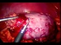Laparoscopic Partial Kidney Excision Due To Renal Tumor In Solitary Kidney Case