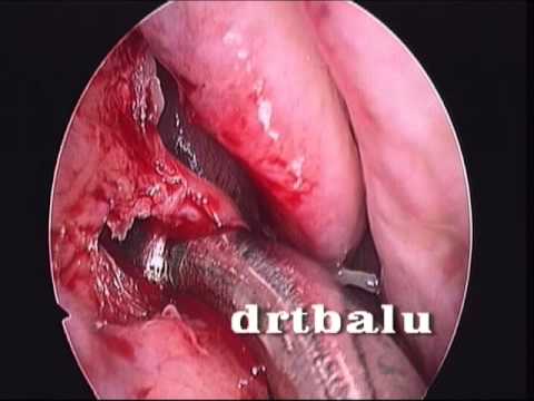how to drain maxillary sinus
