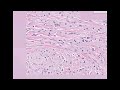 Histopathology Skin--Granular cell tumor