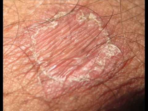 how to remove ringworm