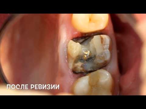 Процент реставрации зубов Процент реставрации зубов